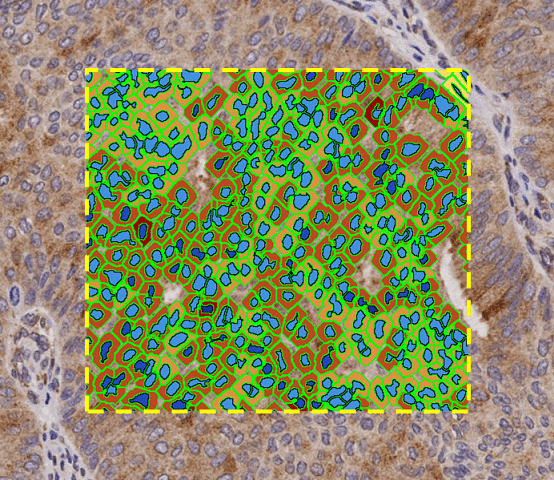 IHC – Brightfield Immunohistochemistry Image Analysis IHC – Brightfield Immunohistochemistry Image Analysis